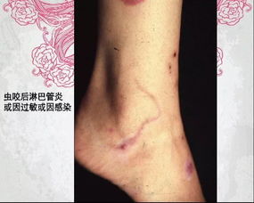 今晚18 08北京大学第一医院皮肤性病科主任医师朱学骏做客 健康北京 小虫子 惹大祸