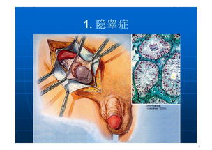 2012北京男科论坛 十 李宏军 男性不育治疗策略北京男科论坛