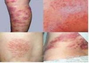 皮炎湿疹的注意事项及北京性病治疗概述