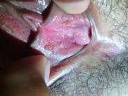 北京湿疣疱疹治疗中心 专业诊疗，守护健康